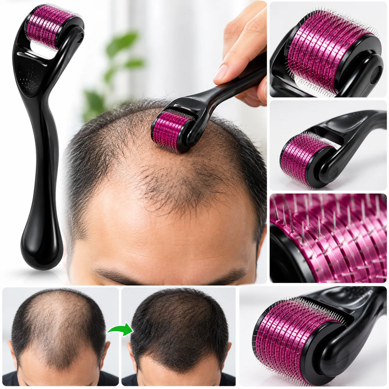 Derma Roller System For Face & Body 0.50mm 540 Needles Derma Roller 2