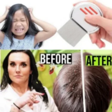 স্টেইনলেস স্টিলের উকুন অপসারণের চিরুনি, Stainless Steel Lice Removal Comb one PCS 1