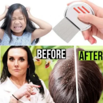 স্টেইনলেস স্টিলের উকুন অপসারণের চিরুনি, Stainless Steel Lice Removal Comb one PCS 2