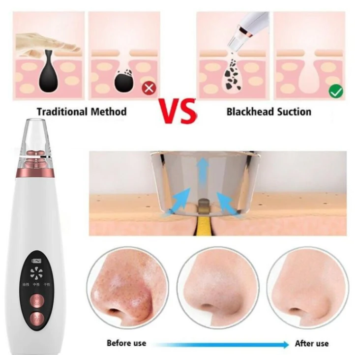 Multi-functional cleaning Blackhead Remover 4